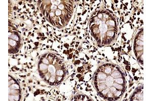 Paraformaldehyde-fixed, paraffin embedded human colon cancer, Antigen retrieval by boiling in sodium citrate buffer (pH6) for 15min, Block endogenous peroxidase by 3% hydrogen peroxide for 30 minutes,  Blocking buffer (normal goat serum) at 37°C for 20min, Antibody incubation with NDRG1 (Thr346) Polyclonal Antibody at 1:400 overnight at 4°C, followed by a conjugated secondary and DAB staining. (NDRG1 antibody  (pThr346))