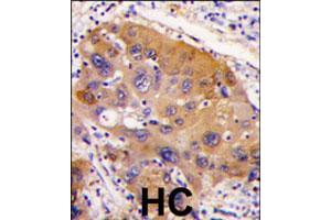 Formalin-fixed and paraffin-embedded human hepatocellular carcinoma reacted with NNMT polyclonal antibody  , which was peroxidase-conjugated to the secondary antibody, followed by DAB staining. (NNMT antibody  (AA 77-106))