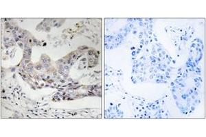 Immunohistochemistry analysis of paraffin-embedded human breast carcinoma tissue, using ALDH3B1 Antibody. (ALDH3B1 antibody  (AA 51-100))