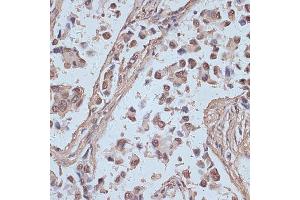 Immunohistochemistry of paraffin-embedded human lung cancer using SNW1 antibody (ABIN7270386) at dilution of 1:100 (40x lens). (SNW1 antibody  (AA 300-536))