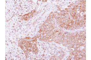 IHC-P Image Immunohistochemical analysis of paraffin-embedded human breast cancer, using GSPT1, antibody at 1:500 dilution.