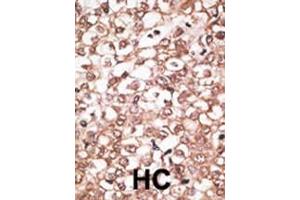 Formalin-fixed and paraffin-embedded human cancer tissue reacted with the primary antibody, which was peroxidase-conjugated to the secondary antibody, followed by AEC staining. (ABCB11 antibody  (C-Term))