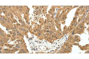 Immunohistochemistry of paraffin-embedded Human ovarian cancer using PTCH1 Polyclonal Antibody at dilution of 1:50 (Patched 1 antibody)