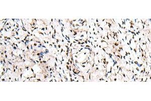 Immunohistochemistry of paraffin-embedded Human cervical cancer tissue using ZNF207 Polyclonal Antibody at dilution of 1:30(x200) (ZNF207 antibody)