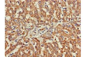 Immunohistochemistry of paraffin-embedded human liver cancer using ABIN7142959 at dilution of 1:100 (CHRNB1 antibody  (AA 24-244))