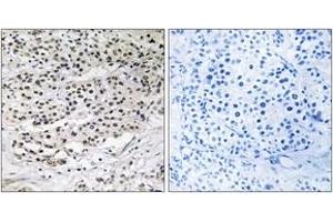 Immunohistochemistry analysis of paraffin-embedded human breast carcinoma tissue, using AZI1 Antibody. (AZI1 antibody  (AA 311-360))
