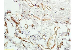 Formalin-fixed and paraffin embedded human colon carcinoma labeled with Rabbit Anti PAR4 Polyclonal Antibody, Unconjugated (ABIN673224) at 1:200 followed by conjugation to the secondary antibody and DAB staining