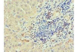 Immunohistochemistry of paraffin-embedded human liver cancer using ABIN7156754 at dilution of 1:100 (IRAK2 antibody  (AA 1-270))