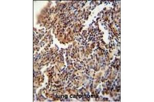 HFM1 antibody (C-term) (ABIN654571 and ABIN2844275) immunohistochemistry analysis in formalin fixed and paraffin embedded human lung carcinoma followed by peroxidase conjugation of the secondary antibody and DAB staining. (HFM1 antibody  (C-Term))