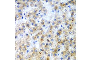 Immunohistochemistry of paraffin-embedded human liver cancer using LY86 antibody (ABIN5975008) at dilution of 1/200 (40x lens). (LY86 antibody)