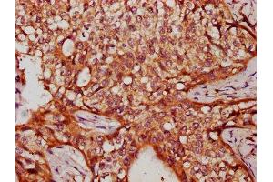 IHC image of ABIN7175349 diluted at 1:300 and staining in paraffin-embedded human cervical cancer performed on a Leica BondTM system. (Valyl-tRNA Synthetase 2, Mitochondrial (VARS2) (AA 830-981) antibody)