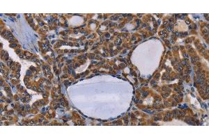 Immunohistochemistry of paraffin-embedded Human thyroid cancer tissue using GRK3 Polyclonal Antibody at dilution 1:50 (ADRBK2 antibody)