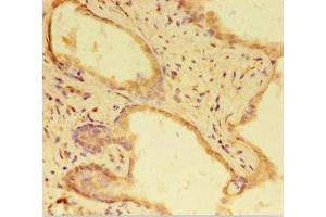 Immunohistochemistry of paraffin-embedded human prostate cancer using ABIN7168303 at dilution of 1:100