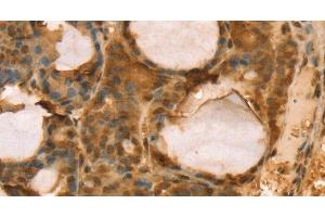 Immunohistochemistry of paraffin-embedded Human thyroid cancer using TAF11 Polyclonal Antibody at dilution of 1:40 (TAF11 antibody)