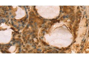 Immunohistochemistry of paraffin-embedded Human thyroid cancer using TAF11 Polyclonal Antibody at dilution of 1:40