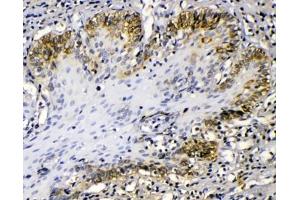 IHC testing of FFPE human esophageal squamous cancer with Cytokeratin 14 antibody at 1ug/ml. (KRT14 antibody  (AA 446-472))