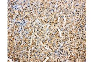 Anti-Kallistatin antibody, IHC(P) IHC(P): Human Liver Cancer Tissue (SERPINA4 antibody  (C-Term))