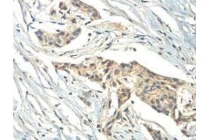 Immunohistochemical analysis of paraffin-embedded human breast carcinoma showing cytoplasmic staining with ZC3H11A polyclonal antibody  at a 1 : 100 dilution. (ZC3H11A antibody  (AA 332-585))