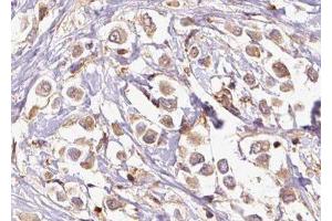 ABIN6277339 at 1/100 staining Human breast cancer tissue by IHC-P. (PDCD10 antibody  (Internal Region))
