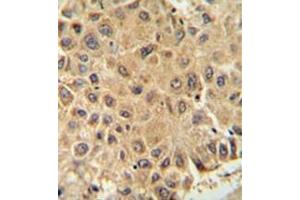 Immunohistochemistry analysis in formalin fixed and paraffin embedded human prostate carcinoma reacted with ISCA2 / HBLD1 Antibody (Center) followed which was  peroxidase conjugated to the secondary antibody and followed by DAB staining. (ISCA2 antibody  (Middle Region))