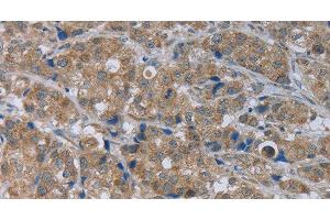 Immunohistochemistry of paraffin-embedded Human breast cancer using GABRB1 Polyclonal Antibody at dilution of 1:50 (GABRB1 antibody)