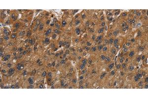 Immunohistochemistry of paraffin-embedded Human gastric cancer using ITGB7 Polyclonal Antibody at dilution of 1:40 (Integrin beta 7 antibody)