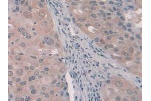 Detection of PCI in Human Breast Cancer Tissue using Polyclonal Antibody to Protein C Inhibitor (PCI) (SERPINA5 antibody  (AA 43-406))
