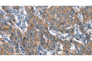 Immunohistochemistry of paraffin-embedded Human gastic cancer using CHMP1A Polyclonal Antibody at dilution of 1:60 (CHMP1A antibody)
