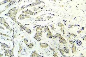 Immunohistochemistry analysis of phospho-PRKAA1 antibody (pSer486) in paraffin-embedded human breast carcinoma tissue. (PRKAA1 antibody  (pSer487, pSer491))