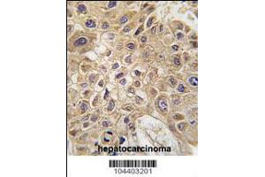 Formalin-fixed and paraffin-embedded human hepatocarcinoma tissue reacted with AMFR Antibody , which was peroxidase-conjugated to the secondary antibody, followed by DAB staining. (GPI antibody  (AA 571-601))