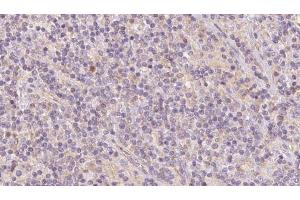 ABIN6273101 at 1/100 staining Human lymph cancer tissue by IHC-P. (CKMT1 antibody  (N-Term))