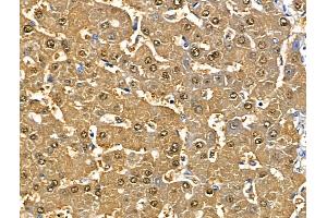 ABIN6265219 and ABIN6268746 at 1/100 staining Human liver cancer and adjacent normal tissues by IHC-P. (SOD1 antibody  (Internal Region))