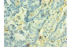 Immunohistochemistry of paraffin-embedded human lung cancer using ABIN7171227 at dilution of 1:100 (Syntaxin 12 antibody  (AA 1-250))