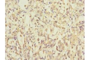 Immunohistochemistry of paraffin-embedded human gastric cancer using ABIN7142352 at dilution of 1:100 (MRPL12 antibody  (AA 1-198))