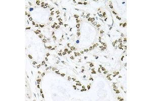 Immunohistochemistry of paraffin-embedded human gastric cancer using BCCIP antibody. (BCCIP antibody  (AA 1-314))