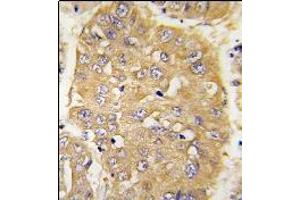 Formalin-fixed and paraffin-embedded human hepatocarcinoma tissue reacted with AP14345PU-N IGFBP3 Antibody (N-term) which was peroxidase-conjugated to the secondary antibody, followed by DAB staining. (IGFBP3 antibody  (N-Term))