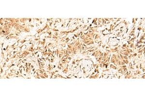 Immunohistochemistry of paraffin-embedded Human ovarian cancer tissue using HNF4A Polyclonal Antibody at dilution of 1:40(x200) (HNF4A antibody)