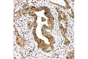 Anti-Integrin alpha 3 antibody, IHC(P) IHC(P): Human Intestinal Cancer Tissue (ITGA3 antibody  (N-Term))