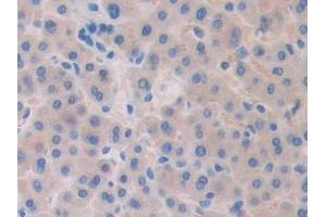 Detection of Slit1 in Human Liver cancer Tissue using Polyclonal Antibody to Slit Homolog 1 (Slit1) (SLIT1 antibody  (AA 647-835))