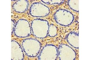 Immunohistochemistry of paraffin-embedded human gastric cancer using ABIN7153143 at dilution of 1:100 (CX3CL1 antibody  (AA 25-100))