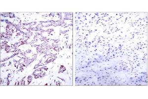 Immunohistochemical analysis of paraffin-embedded human breast carcinoma tissue using STAT6 (phospho-Thr645) antibody (E011051). (STAT6 antibody  (pThr645))