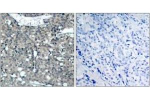 Immunohistochemistry analysis of paraffin-embedded human breast carcinoma tissue, using Paxillin (Ab-118) Antibody. (Paxillin antibody  (AA 85-134))