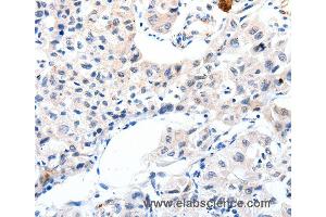 Immunohistochemistry of Human lung cancer using IGFBP7 Polyclonal Antibody at dilution of 1:25