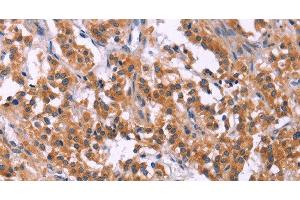 Immunohistochemistry of paraffin-embedded Human thyroid cancer tissue using MSMO1 Polyclonal Antibody at dilution 1:40 (SC4MOL antibody)