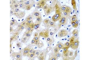 Immunohistochemistry of paraffin-embedded Human liver damage using SECISBP2 Polyclonal Antibody at dilution of 1:200 (40x lens). (SECISBP2 antibody)