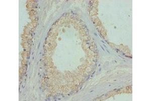 Immunohistochemistry of paraffin-embedded human prostate cancer using ABIN7152449 at dilution of 1:100 (FBXO7 antibody  (AA 353-522))