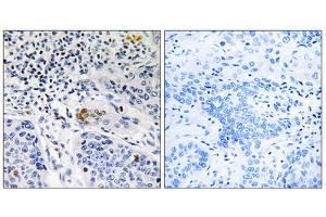 Immunohistochemistry analysis of paraffin-embedded human lung carcinoma tissue, using ZBTB40 antibody. (ZBTB40 antibody  (C-Term))