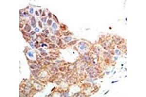 IHC analysis of FFPE human breast carcinoma tissue stained with the PRMT5 antibody (PRMT5 antibody  (AA 591-621))