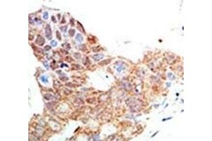 IHC analysis of FFPE human breast carcinoma tissue stained with the PRMT5 antibody