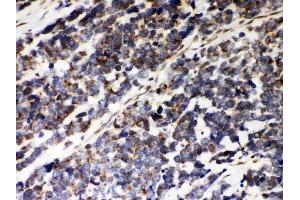 Anti-Peroxiredoxin 5 Picoband antibody, (ABIN3043906), IHC(P)IHC(P): Human Lung Cancer Tissue